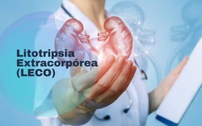 Litotripsia Extracorpórea (LECO) para tratamento de Cálculos Renais